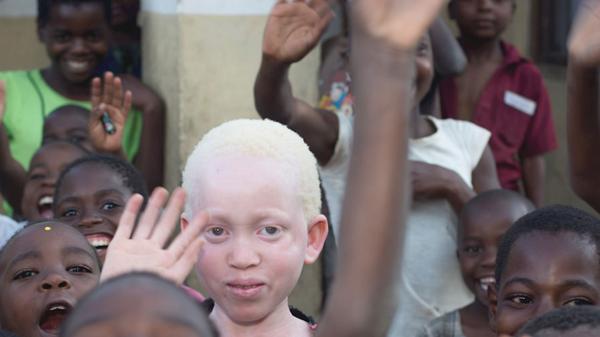 albinos4