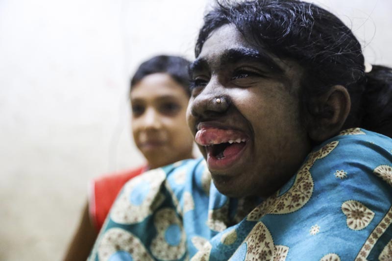GRA013. DACCA, 28/05/2016.- Bithi Akthar, de 12 años, sonríe en una habitación del Hospital Universitario Bangabandhu Sheikh Mujib de Dacca, el 25 de mayo de 2016. La familia de Bithi acudió a curanderos o a la religión para intentar acabar con el manto de pelo que cubre a su niña, pero no fue hasta su llegada a un hospital capitalino en Bangladesh donde se vislumbró la posibilidad de curarla de lo que parece un probable caso del síndrome del hombre lobo. A Bithi le cuesta pronunciar las palabras. La timidez y unas enormes encías superiores que cubren completamente sus dientes lo dificultan, aunque está contenta porque su cara empieza a perder el vello gracias a una primera sesión de láser. EFE/Igor G. Barbero