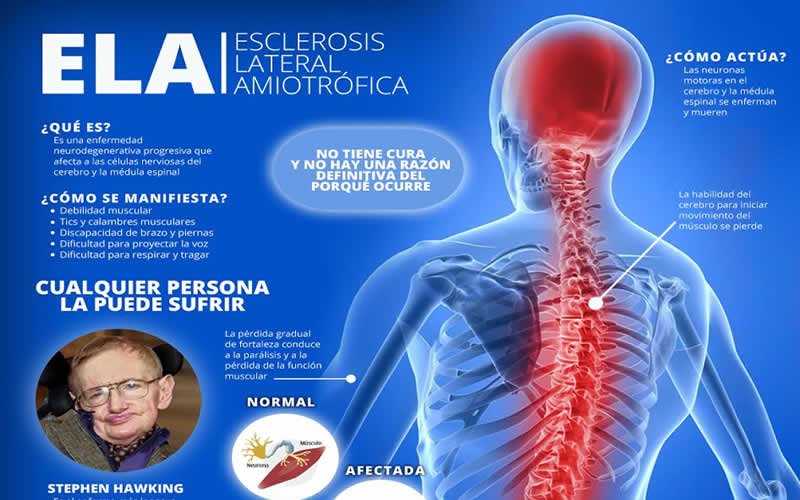 esclerosis lateral amiotrófica