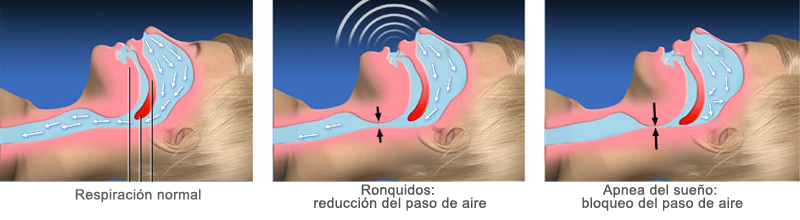 apnea-del-sueño