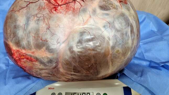 Tumor de tamaño aproximado de 50 cm x 50 cm y con un peso de 15.4 kilos